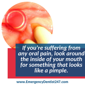 dealing with an oral infection - emergency dentist 247 san jose