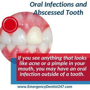 emergency dentist 247 indianapolis oral infections and abscessed tooth