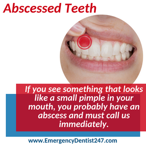 emergency dentist 247 phoenix az - abscessed teeth