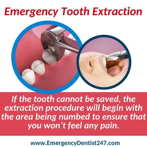 emergency dentist 247 phoenix az - tooth extraction