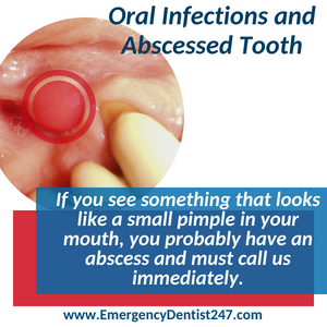 emergency dentist 247 san antonio tx - abscessed tooth