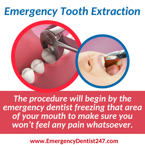 emergency dentist 247 san francisco - emergency tooth extraction