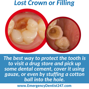 emergency dentist 247 san francisco - lost crown or filling