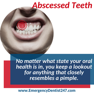 emergency dentist san diego 247 abscessed teeth and oral infections