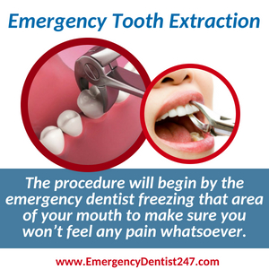 emergency dentist san diego 247 emergency tooth extraction