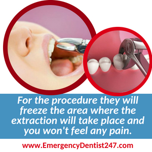 having an emergency tooth extraction done in austin tx