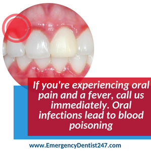 infections of the mouth - emergency dental 247 austin