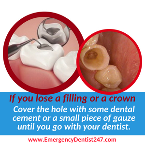 losing a crown or a filling lincroft nj emergency dentist 247