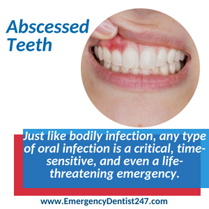 abscessed teeth oral infections seattle