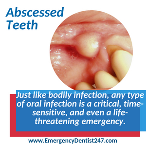 abscessed teeth oral infections