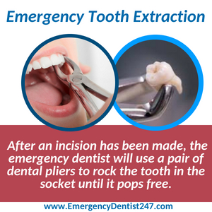 emergency tooth extraction boston