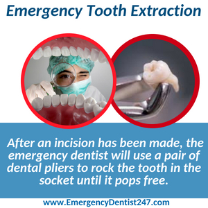 emergency tooth extraction fort worth tx