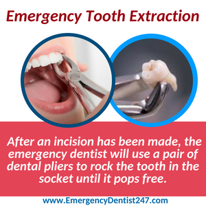 emergency tooth extraction washington dc