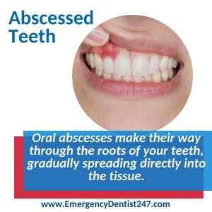 oral infections and abscessed teeth atlanta