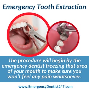 emergency tooth extraction atlanta