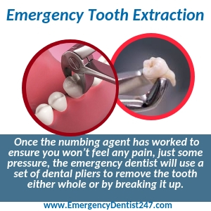 emergency tooth extraction aurora