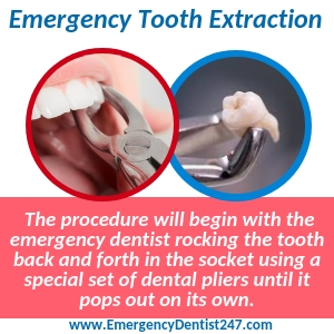 emergency tooth extraction oakland