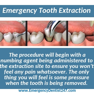 the process of an emergency tooth extraction hartford