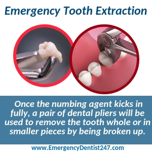 emergency tooth extraction knoxville tn