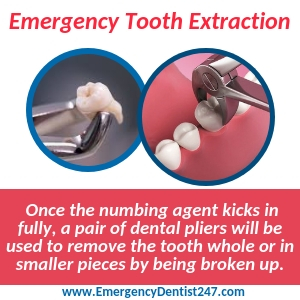 emergency tooth extraction