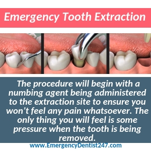 having an emergency tooth extraction tucson