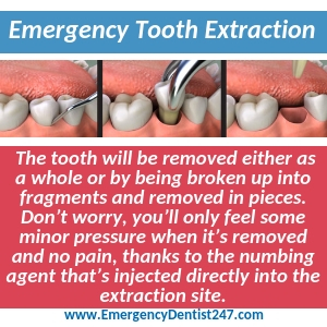 what to expect from an emergency tooth extraction memphis