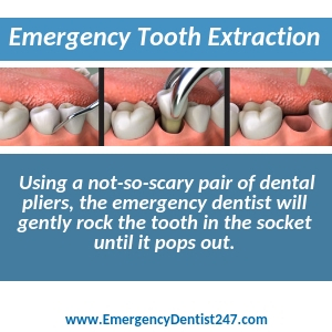 what to expect when you need to have an emergency tooth extraction los angeles