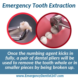 emergency tooth extraction buffalo ny