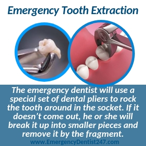 emergency tooth extraction mesa az