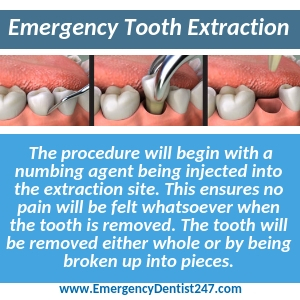 emergency tooth extraction stockton ca