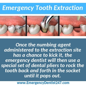 emergency tooth extraction toledo oh