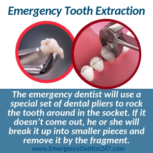 going for an emergency tooth extraction virginia beach